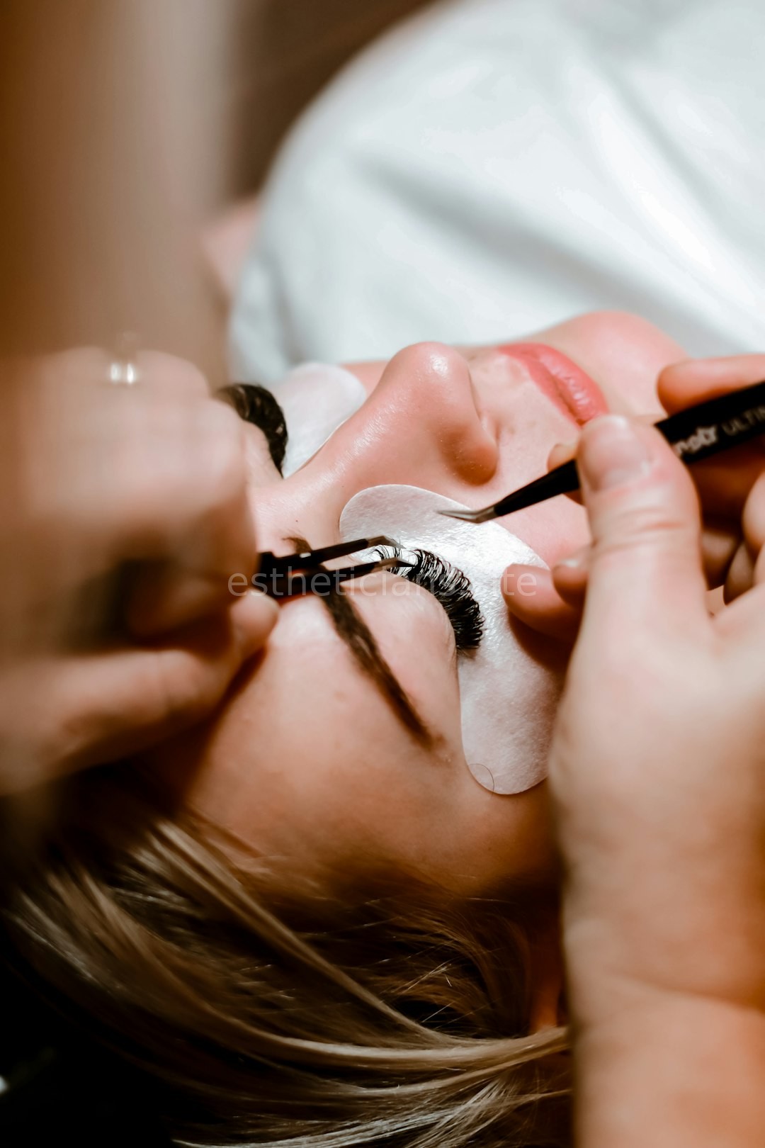 Chemical Peel
